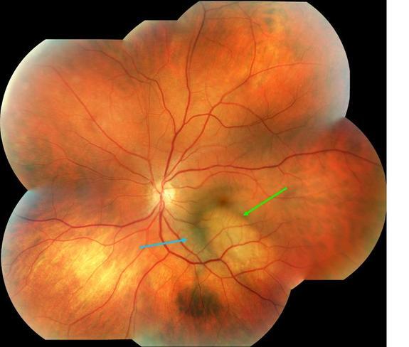 Ocular Melanoma Foundation | OMF - Diagnosis