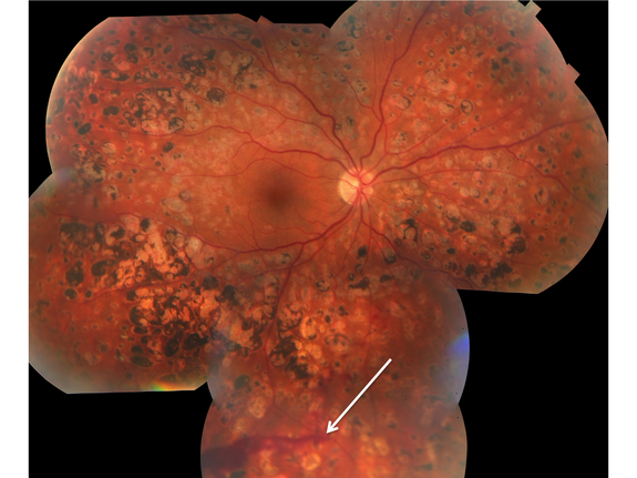 Recurrent Proliferative Diabetic Retinopathy with Vitreous Hemorrhage 