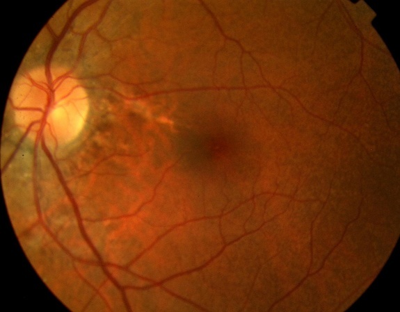 Angioid Streaks Peau Dorange The Retina Reference