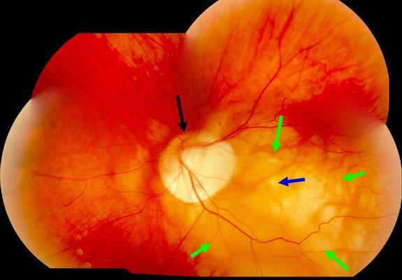 Pathologic Myopia With Staphyloma Macular Hole And Macular Detachment