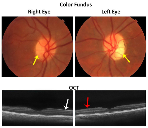 Normal Retinal Anatomy - The Retina Reference