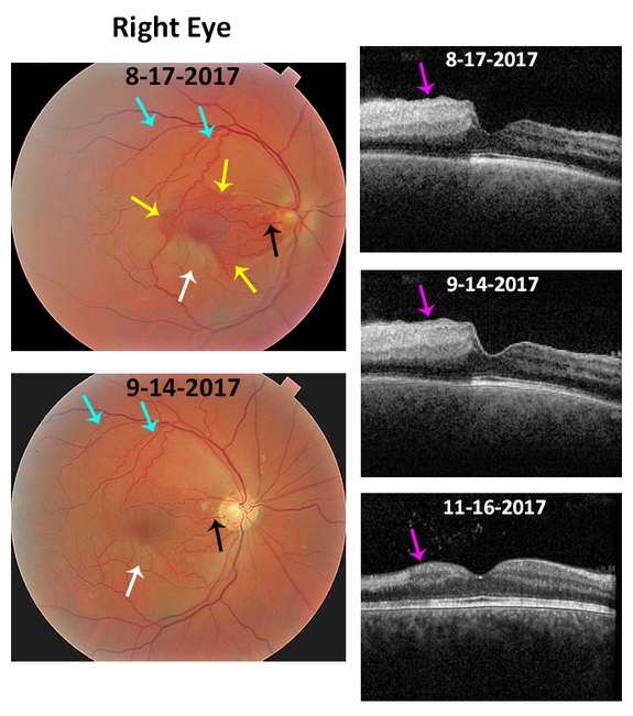 Central Retinal Artery Occlusion Anatomy